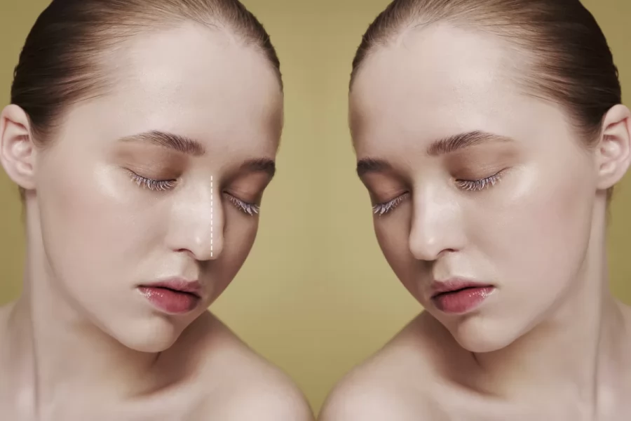 Sakın Burun Estetiği Yaptırmayın! Diyenler Yanılıyor mu?