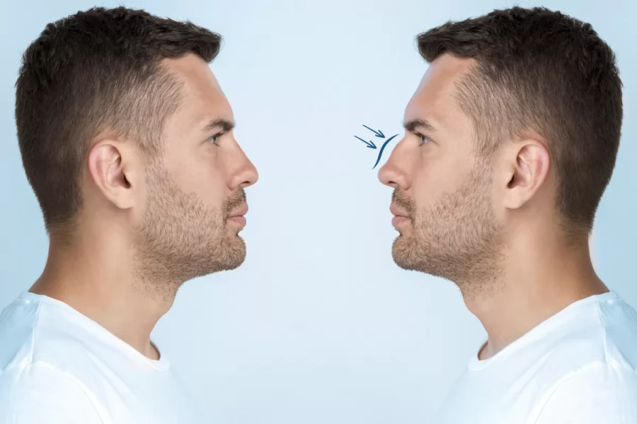 What Should Male Rhinoplasty (Nose Surgery) Be Like?
