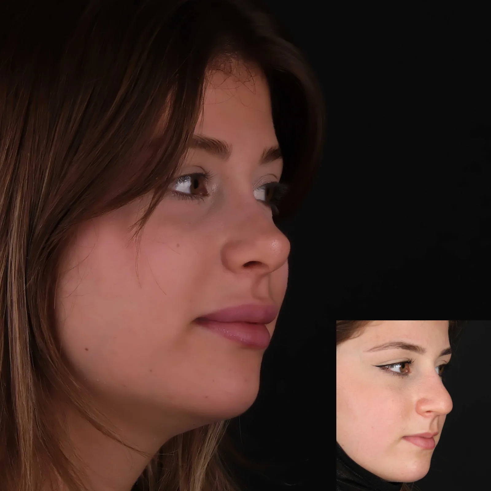Kapalı rinoplasti · profil görünüm