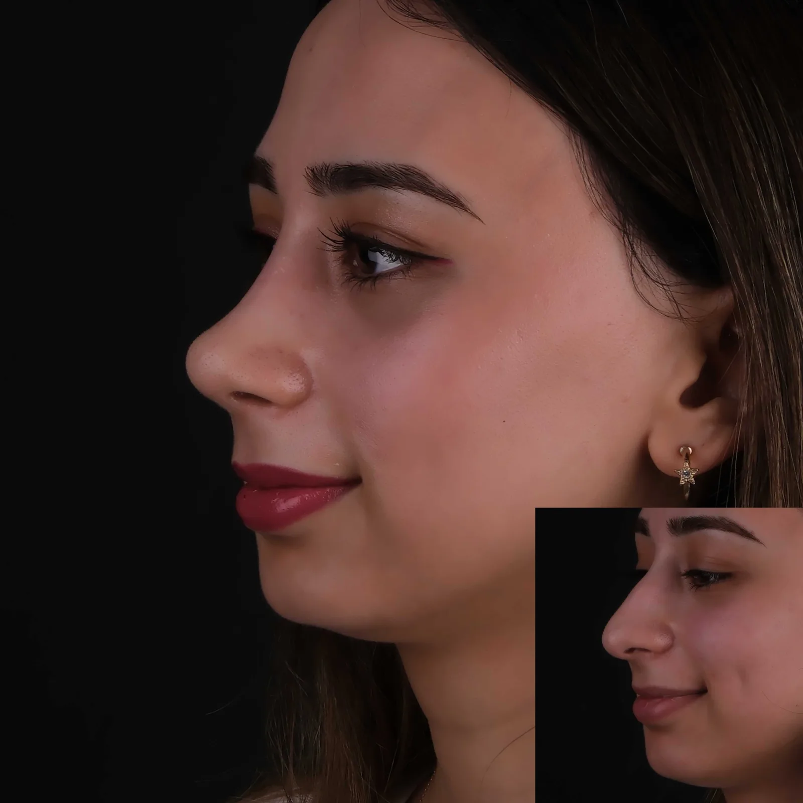 Kapalı Rinoplasti