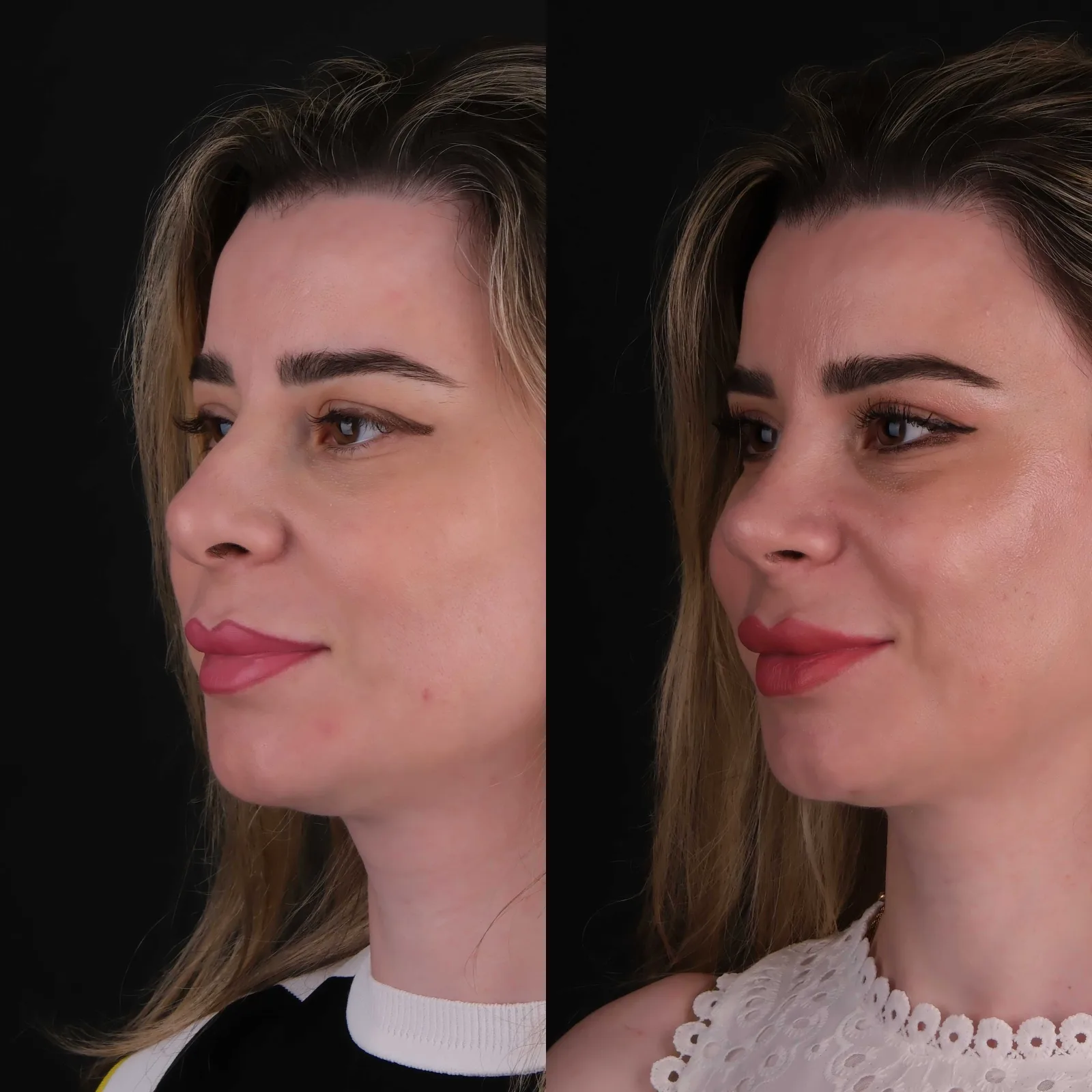 Kapalı Rinoplasti