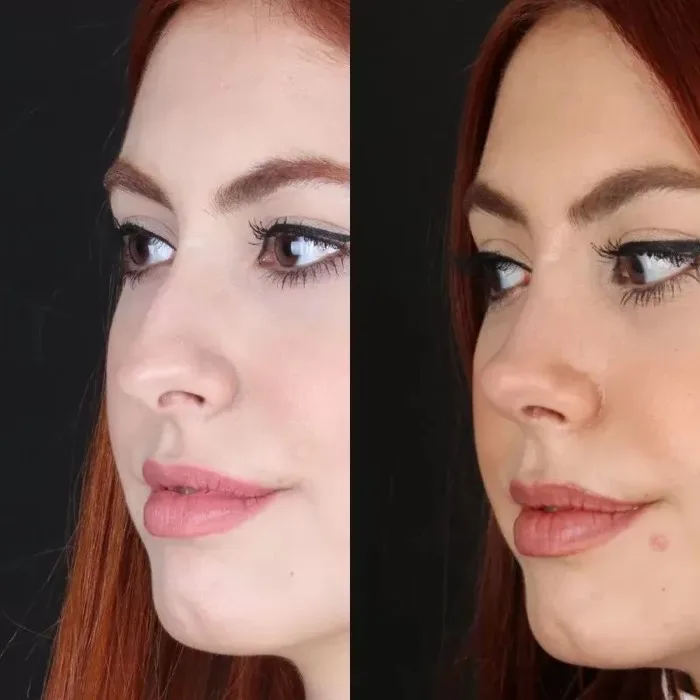 Revizyon Burun Estetiği